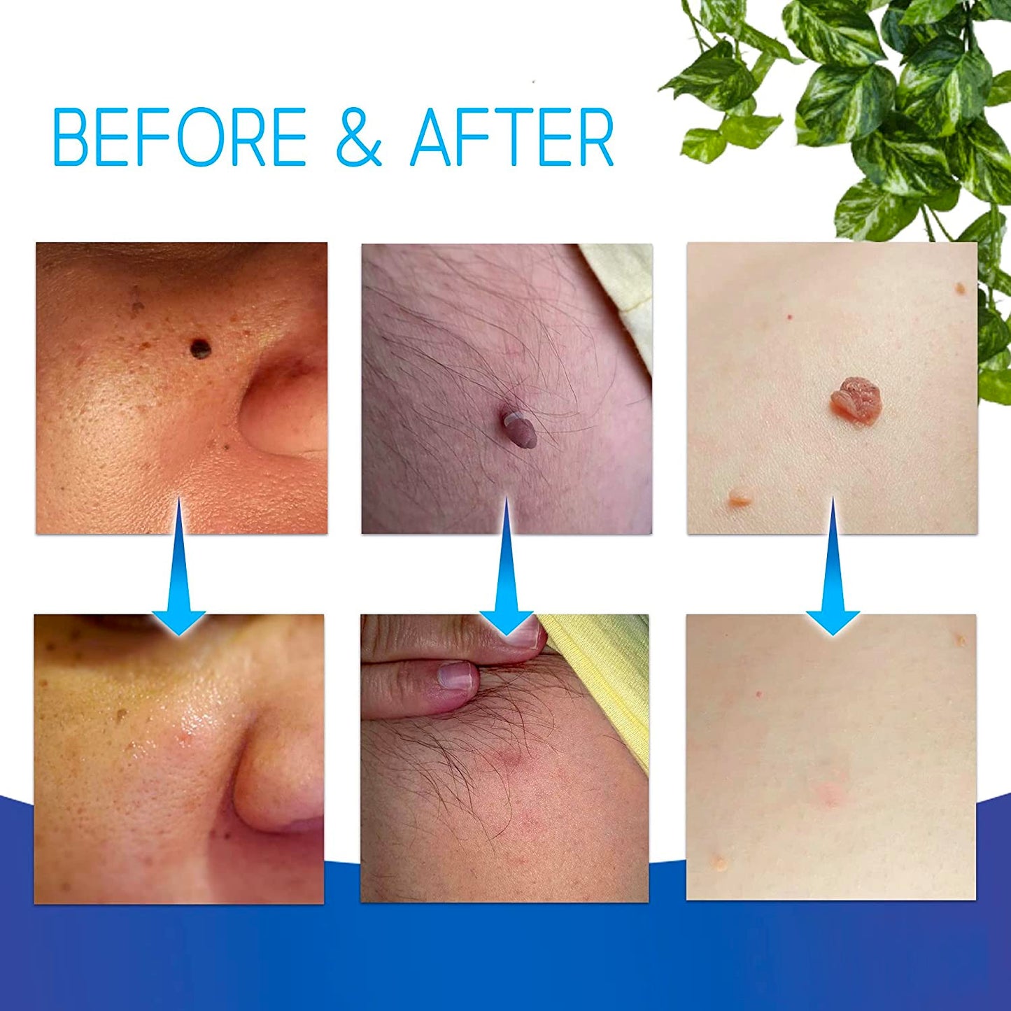 Auto STR Skin Tag Removal Kit. Fast Effective & Safe Skin Tag Remover for Medium/Large Skintags (0.16-0.25in / 4-6mm) - One-Hand Application in Minutes, Includes Pen, Loading Cone, 10 Bands & 10 Wipes